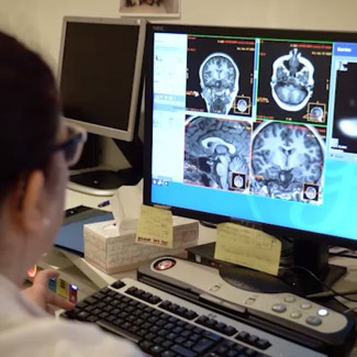Detectan con un análisis de sangre un mecanismo clave en el desarrollo del Alzheimer
