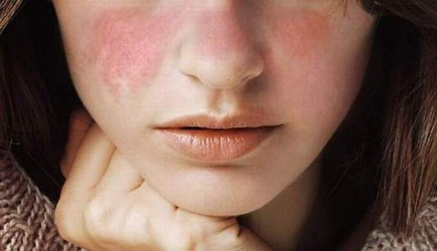 Lupus