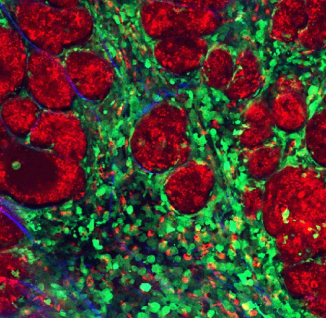 Archivo - Los componentes de un tumor.