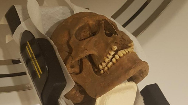 Los cráneos de individuos de la época vikinga fueron examinados con tomografía computarizada moderna, en busca de infecciones, inflamaciones y otras enfermedades.