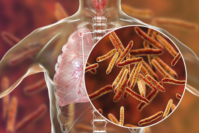 Archivo - Tuberculosis