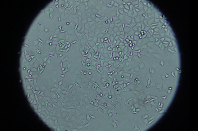 Investigadores logran anular una proteína presente en las células para mejorar la quimioterapia en cáncer de páncreas.
