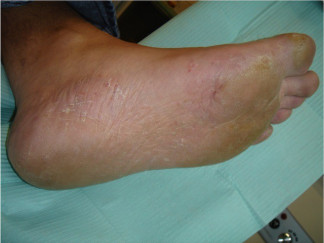 Infección en un pie (micosis).