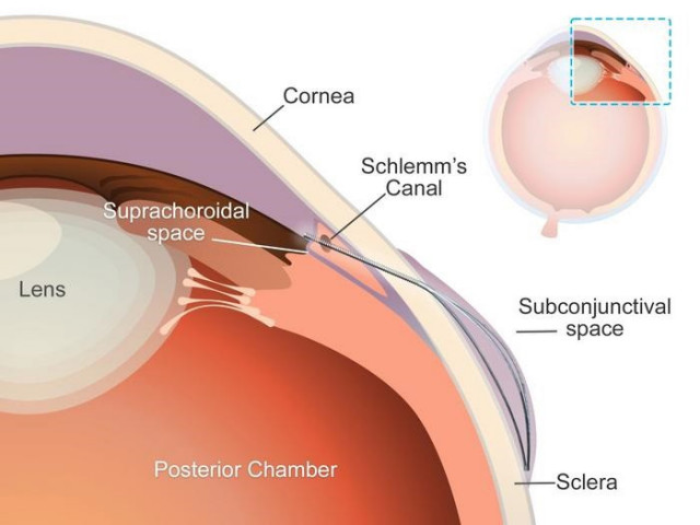 Imagen del 'microstent'.