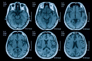 Descubren Un Compuesto Que Podría Cambiar El Tratamiento De Las Lesiones Cerebrales Traumáticas