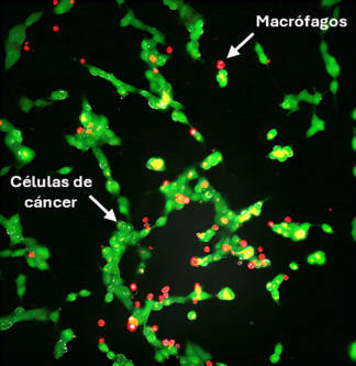 Microscopía electrónica de células de cáncer de neuroblastoma tratadas inicialmente con liposomas y posteriormente macrófagos modificados con liposomas.