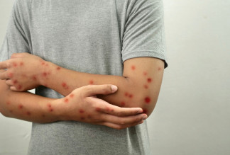 Archivo - Sarampión.