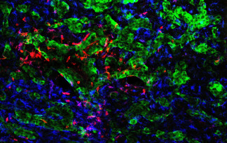 Archivo - El CNIO identifica cómo las células tumorales reprograman el cerebro para favorecer la metástasis