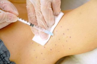 Microinyecciones de toxina botulínica para tratar la hiperhidrosis.