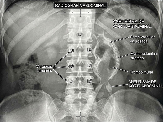 Radiografía abdominal
