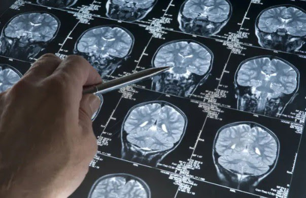 Archivo - IQS estudia el mecanismo de influencia de la diabetes en el deterioro cognitivo y el desarrollo del Alzheimer