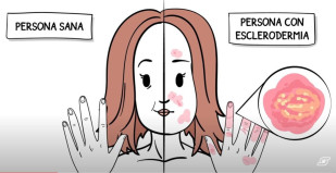 Archivo - En España se estima que hay unas 13.000 personas con esclerodermia, con distinto grado en sus manifestaciones.