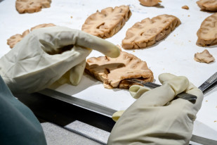 Un análisis de sangre permite estimar el riesgo de Alzheimer en personas sanas hasta una década antes, según un estudio
