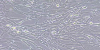 Fibroblastos actúan como escudo en cáncer de vías biliares intrahepático para resistir a quimioterapia, según un estudio