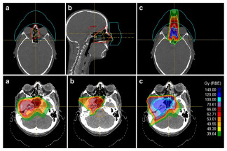 Imagen de cómo la protonterapia concentra la radiación en el tumor durante una reirradiación, preservando al máximo los tejidos sanos ya tratados.
