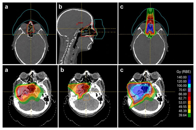 Imagen de cómo la protonterapia concentra la radiación en el tumor durante una reirradiación, preservando al máximo los tejidos sanos ya tratados.