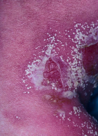 Experto indica que la psoriasis pustulosa generalizada es multisistémica y requiere atención multidisciplinar
