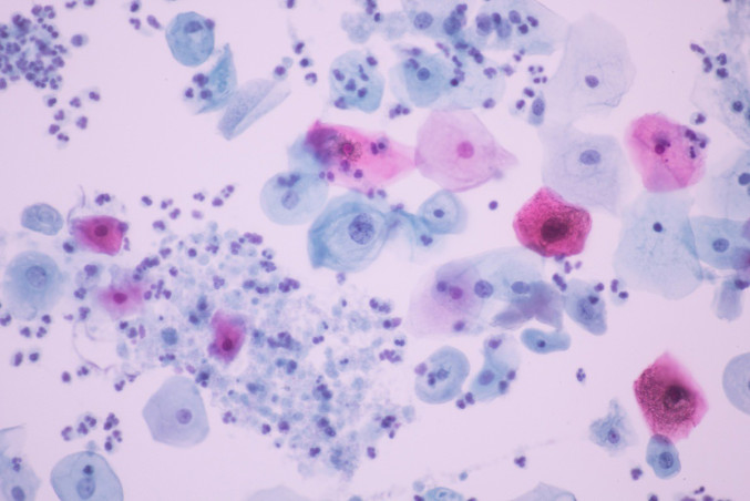 Trichomonas vaginalis, uno de los microorganismos responsables de la infección de transmisión sexual (ITS) no viral más frecuente en el mundo, la tricomoniasis