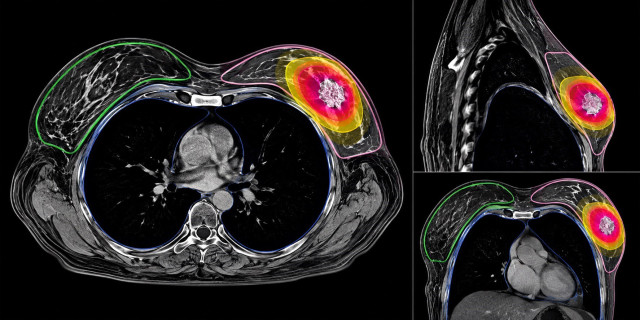 Imágenes de planificación de radioterapia de una paciente con cáncer de mama precoz.